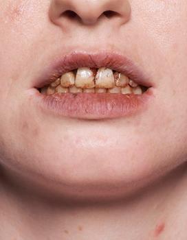 Tooth Enamel - 12 ml
