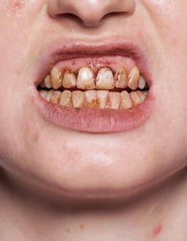 Tooth Enamel - 12 ml
